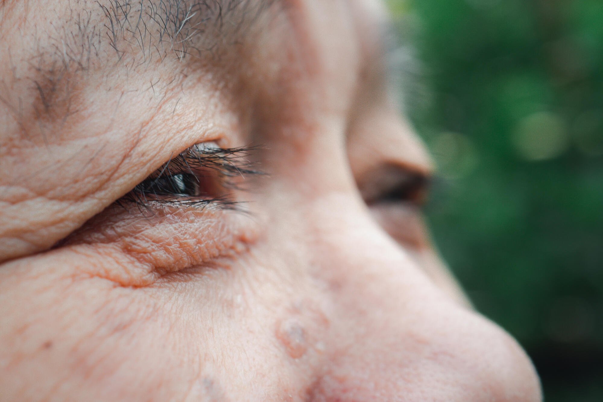 Can Cataracts Come Back? What Seniors Should Know